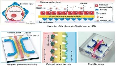 A disease model of diabetic nephropathy in a glomerulus-on-a- chip microdevice